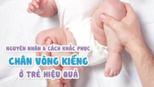 Chân Vòng Kiềng Ở Trẻ